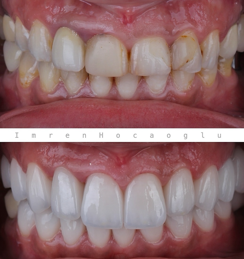 Before After