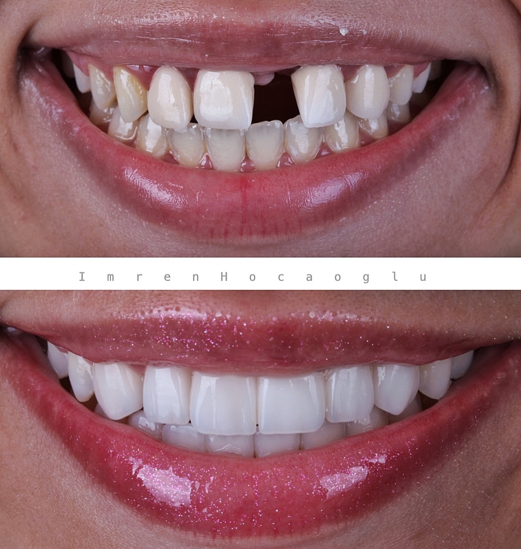 Before After 2