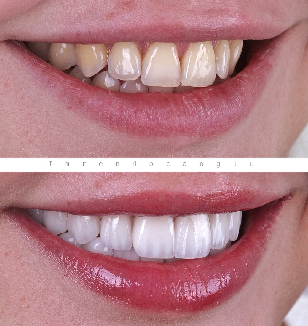 Before After 3