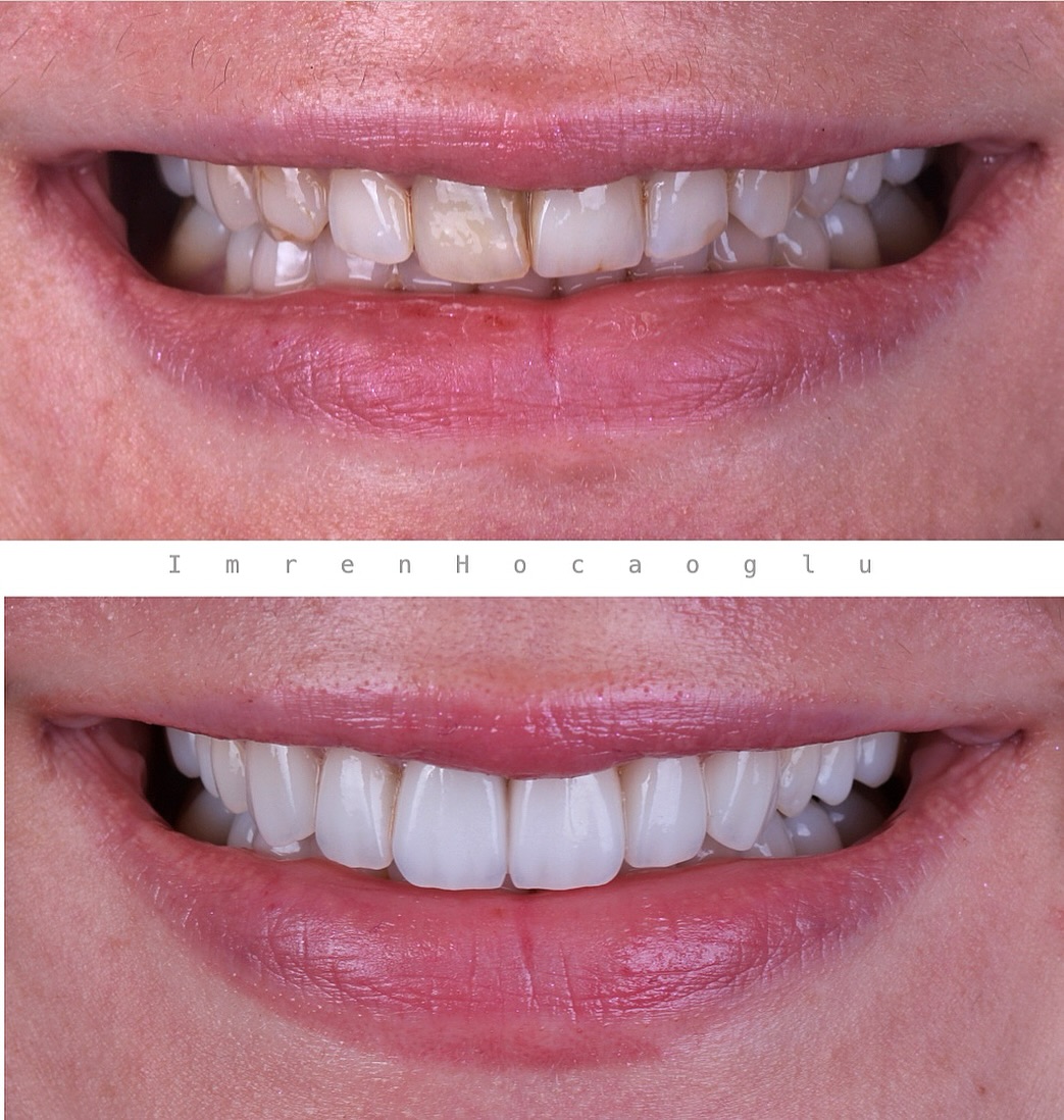 Before After 4