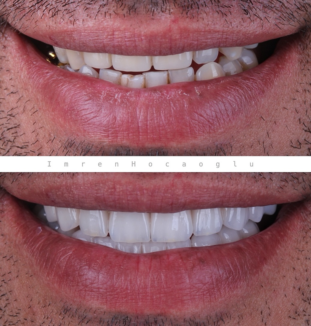 Before After 6