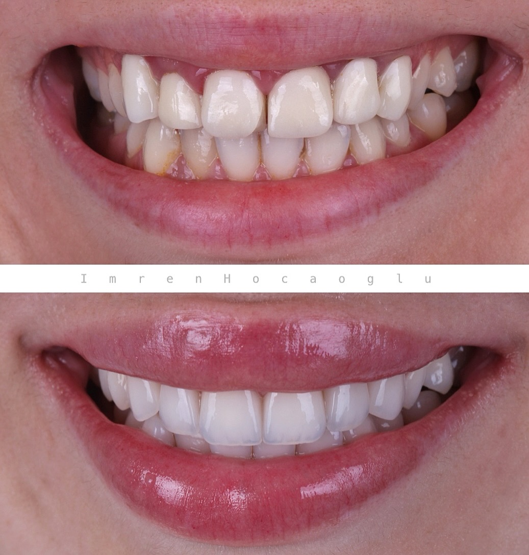 Before After 7