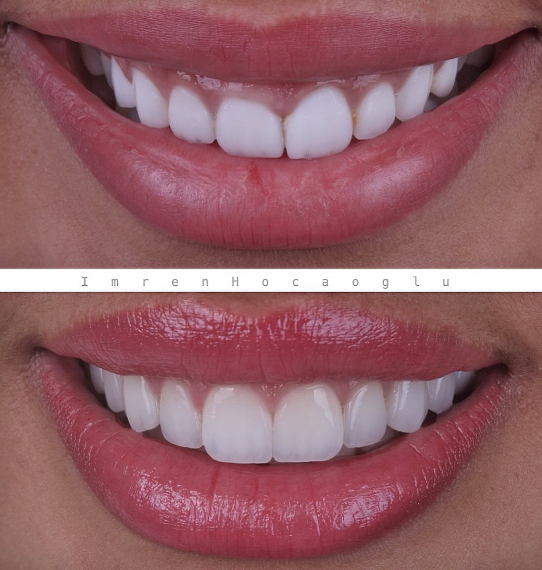 Before After 8